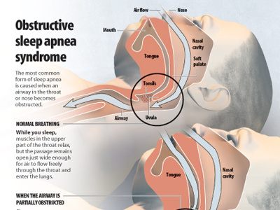 Sleep Apnea Dangers infographic 3d illustration design infographic