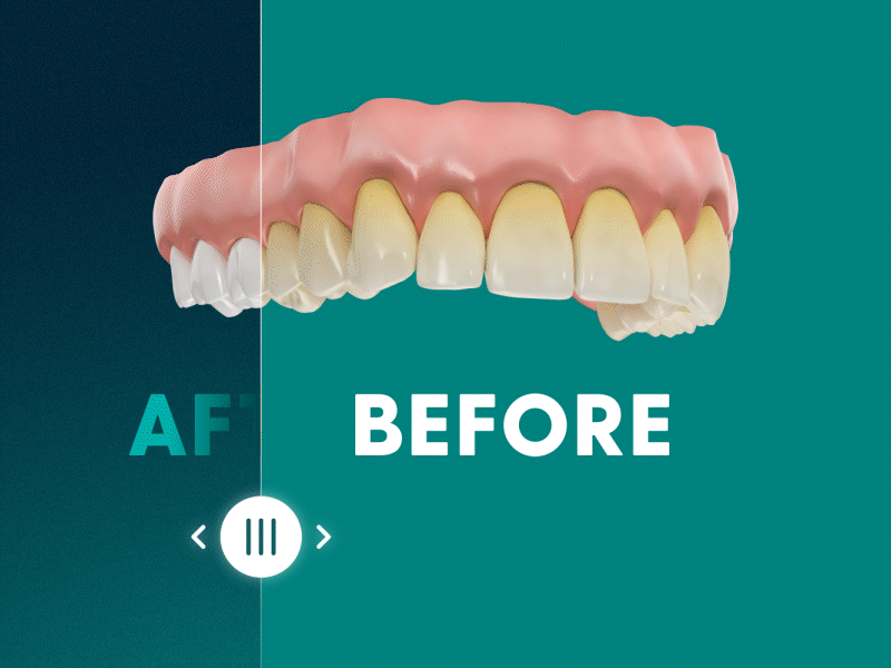 Before and After blanqueamiento clearfy dental design dientes blancos interaction interface motion motion graphics orthodontic ortodoncia teeth treatment uiux
