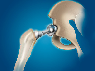 Prosthesis crutch femur hip surgery illustration improvements medical progress prosthesis sketch surgery