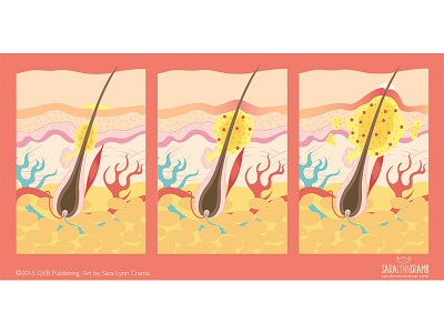 Zits illustration anatomy body cross section diagram educational human illustration physical science pimple sciart skin vector