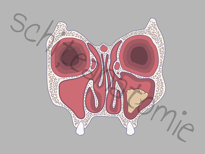 Maxillary rhinosinusitis