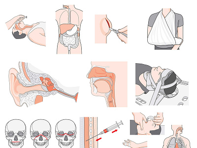 Medical Emergencies how to instructional illustration medical technical illustration technical illustrator vector art