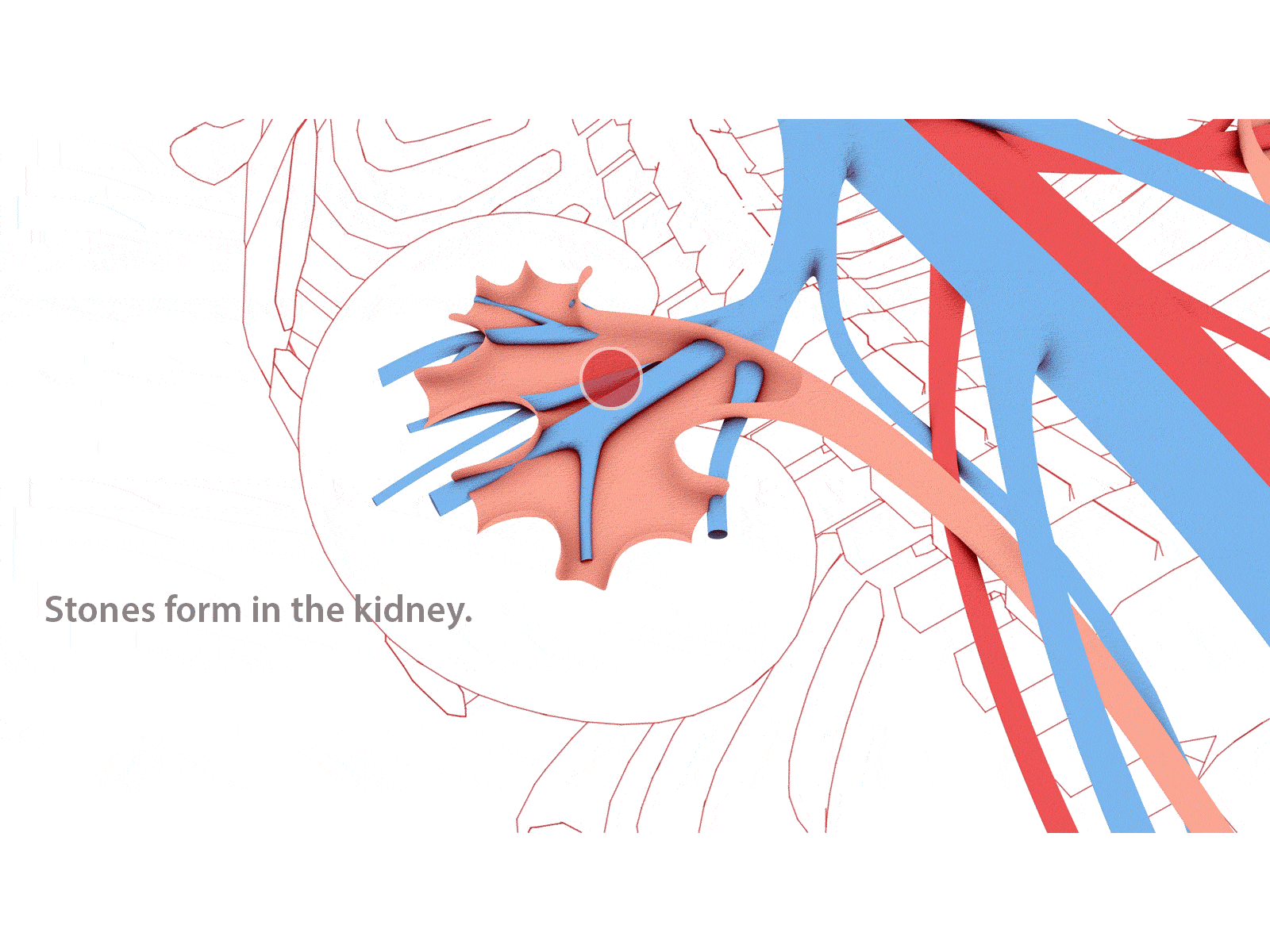 3d animation of kidney stones by JM Gallardo on Dribbble