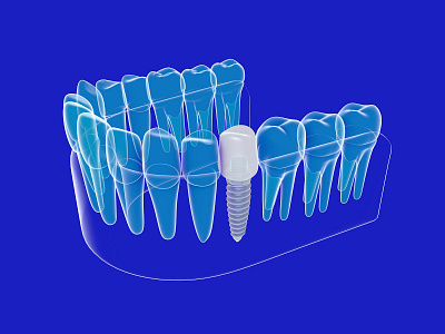 3D illustration of a dental implant. 3d 3d art anatomy dental design illustration medical