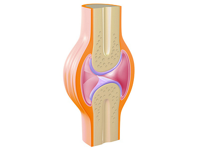 ilustración médica, Artritis illustration