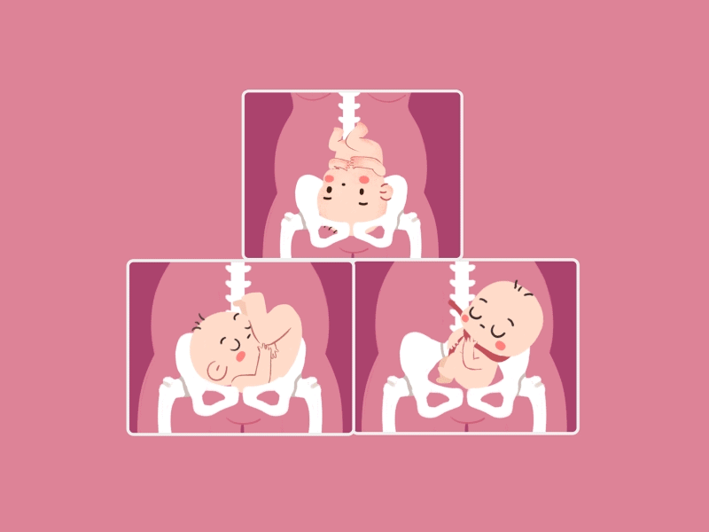 cesarean section animation baby cesarean section design illustration mother
