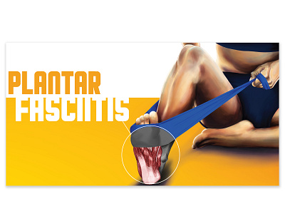 Plantar Fasciitis Digital Ad