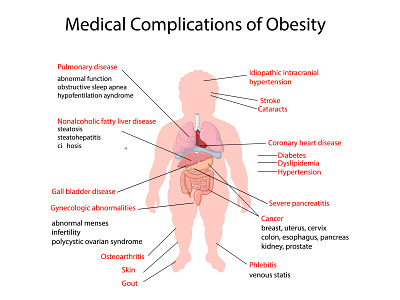 Anatomy of human body anatomical anatomy body cartoon complication fat human illustration infographic internal medical medicine obese obesity organ over overweight science system weight