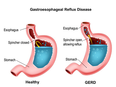 Gastroesophageal reflux disease anatomical anatomy diagram digestion digestive disease disorder gastroesophageal human illness illustration indigestion internal mechanism medical medicine organ stomach structure system