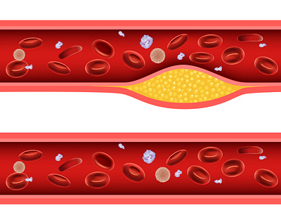 Artery blocked with cholesterol anatomical anatomy arteriosclerosis artery atherosclerosis blood cardiovascular cells cholesterol clot disease human illness illustration internal medical medicine organ system vessel