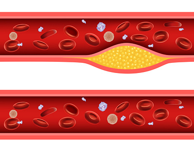 Artery blocked with cholesterol