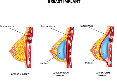 Plastic surgery of breast implant anatomical anatomy bra breast bust cell chest duct gland human illustration implant implantation internal medical organ reproduction scar silicone system