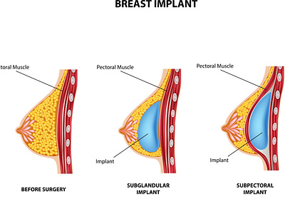 Plastic surgery of breast implant