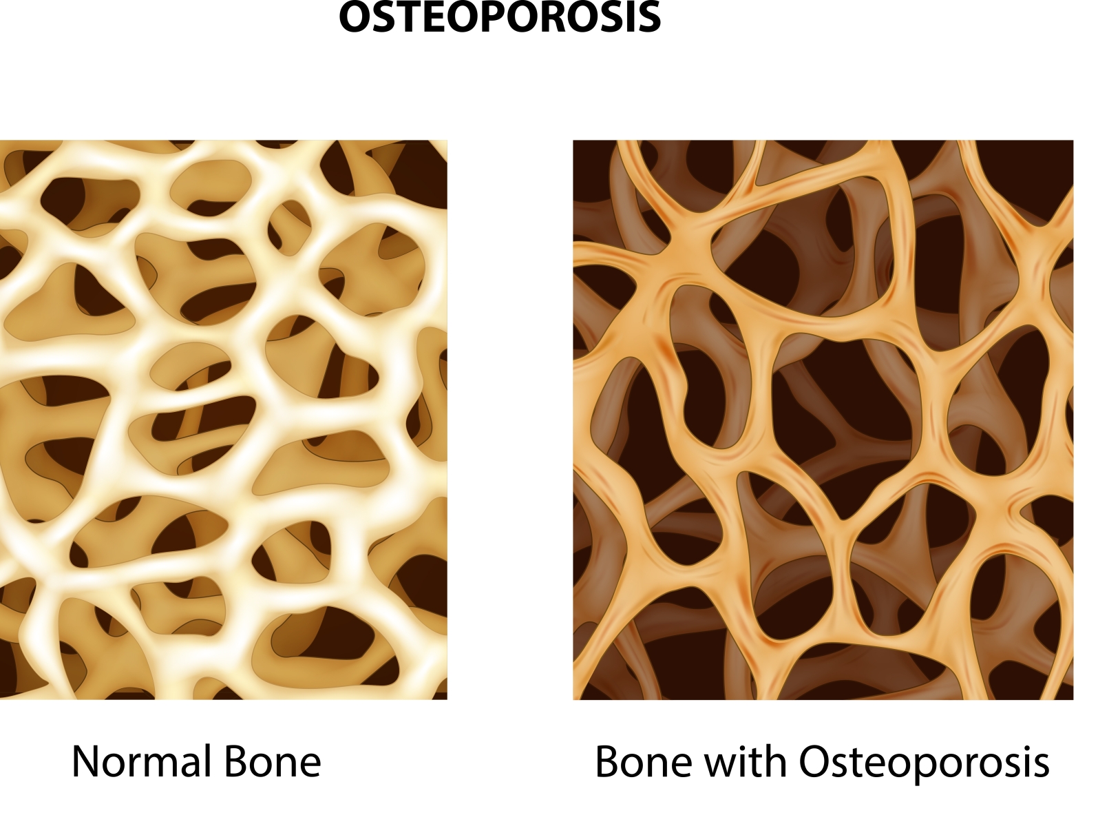 Osteoporosis by Tigatelu on Dribbble