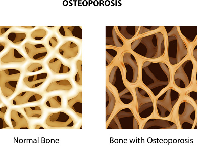 Osteoporosis anatomical anatomy arthritis bone brittle calcium disease femur fracture human illustration inflammation joint medical normal organ orthopedic osteoporosis porous rheumatism