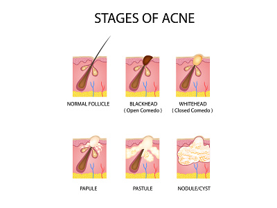 Stages of acne acne anatomy background bacteria care cartoon cell comedo diagram facial illustration medical medicine pore process puberty science skin care stages treatment