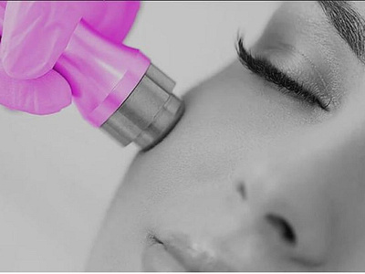 Microdermabrasion Revive Beauty Solutions | Spa London ON