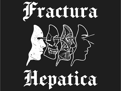 Fractura Hepatica