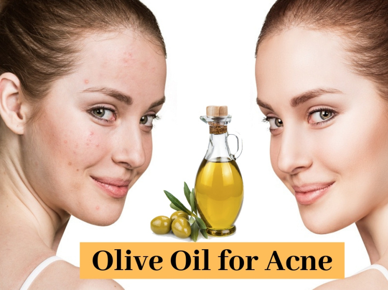 Amazing Benefits of Olive Oil for Acne by emmastone on Dribbble
