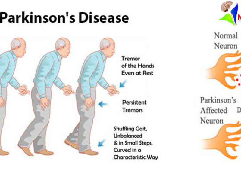 S disease. S disease. Болезнь паркинсона. S disease. Болезнь кастлемана клинические рекомендации.