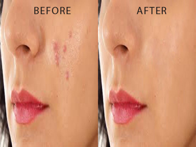 Photoretouching healing photoretouching photoshop photoshop brush pimple remove spotify