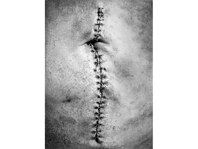 Staples black and white charcoal fine art graphite illustration medical staples