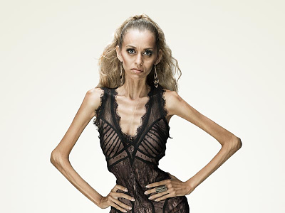 Anorexia