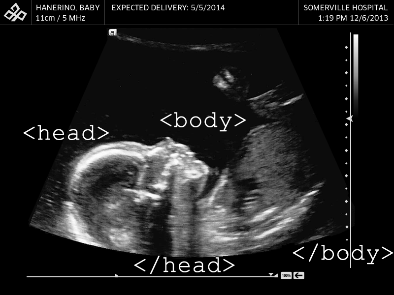 Baby Haney Ultrasound - Markup Congrats