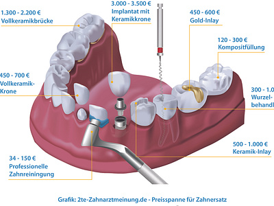 Dental treatment procedure illustration