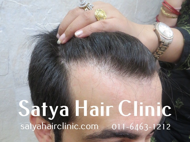 Bio Synthetic Hair Transplant Price In Delhi (India) - Cost of Artificial/Biofibre  Synthetic