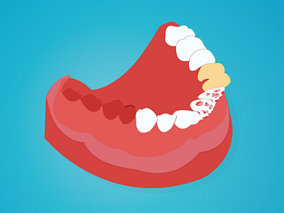 The denture that tells a lot about a Practice cutout denture denturist