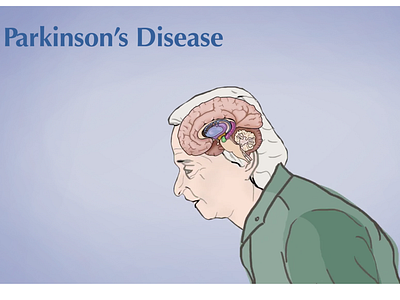 Parkinson's Disease Animation Shot
