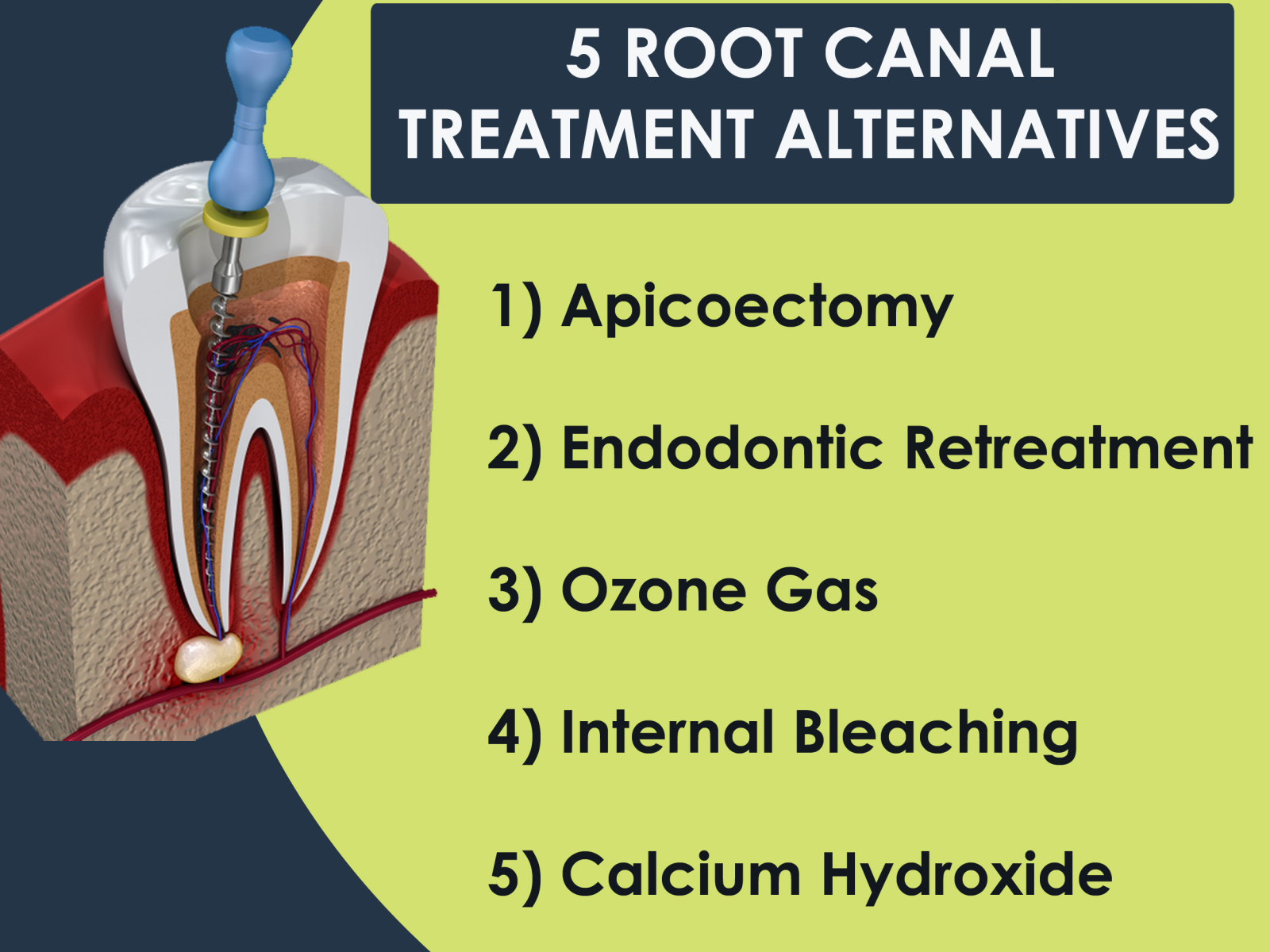 5-root-canal-treatment-alternatives-by-vertia-pargat-on-dribbble