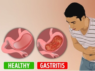 12 Symptoms That Are Rushing to Reveal You Have Gastritis health