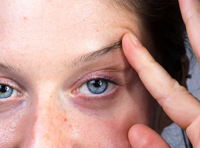Non-Surgical Eyelift - Alternative Treatments for Droopy Eyelids eyelid eyelid lift eyelid tape saggy eyes