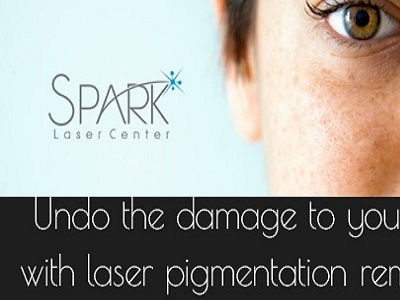 Laser Pigmentation Removal