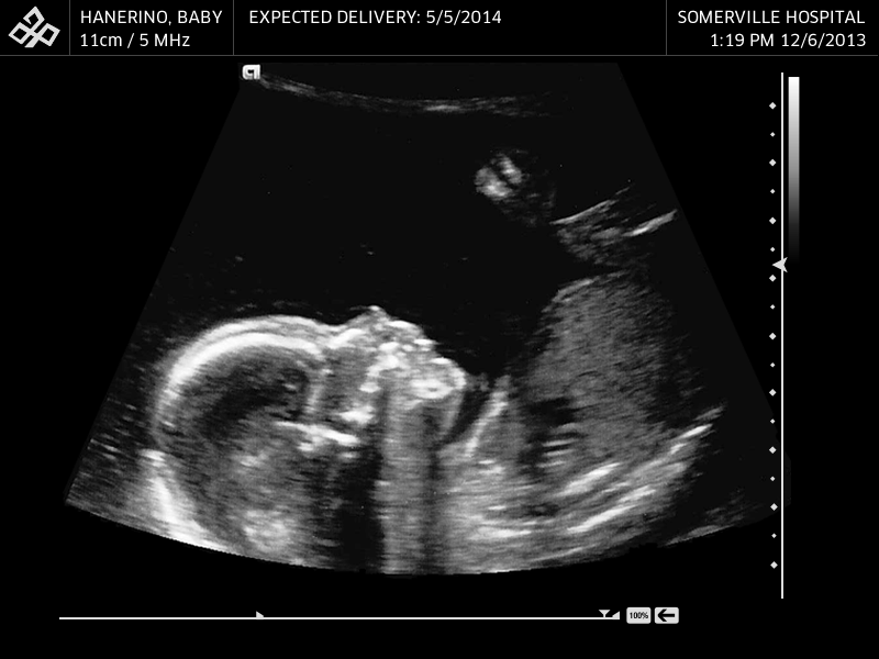 Hanerino Baby animated gif baby ultrasound