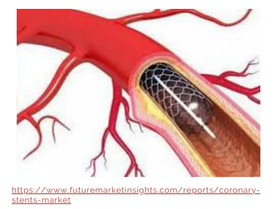 Growth of Coronary stents market coronary stents drug eluting stents