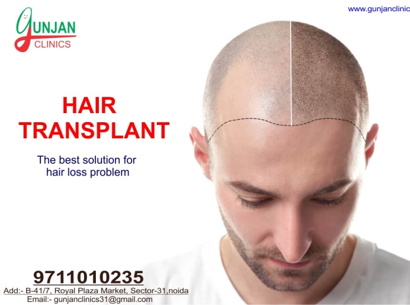 Best Hair Transplant in Noida-hair transplant cost in noida by GUNJAN  CLINICS on Dribbble
