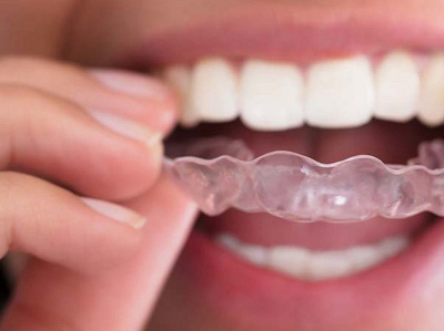 Invisalign