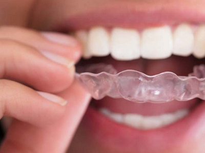 Invisalign 