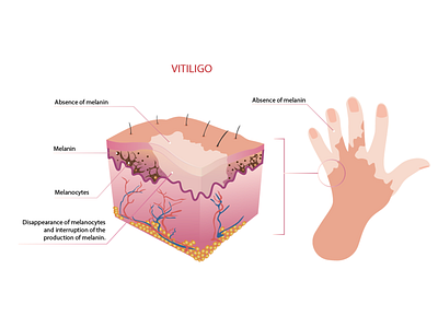 vitiligo absence of melanin graphic design illustration illustration design melanin melanocytes skin vector vitiligo