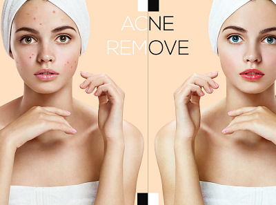 Acne remove