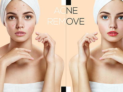 Acne remove