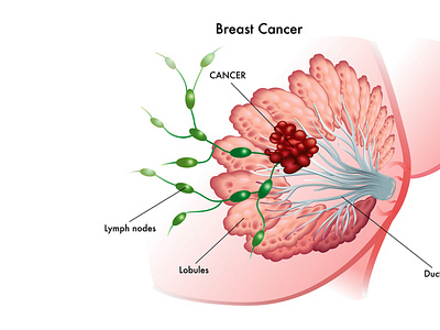 Gynae Cancer Surgery in Punjab