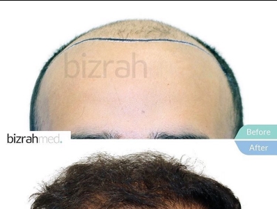 hair transplant cost in dubai