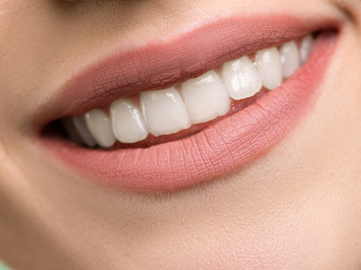 Teeth Whitening in NW Calgary | Springhill Dental