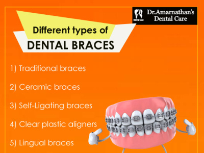 Different types of dental braces dental braces orthodontics teeth braces
