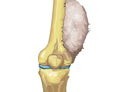 Sarcoma de Ewing afección digital ink enfermedad huesos sarcoma ser humano sistema óseo