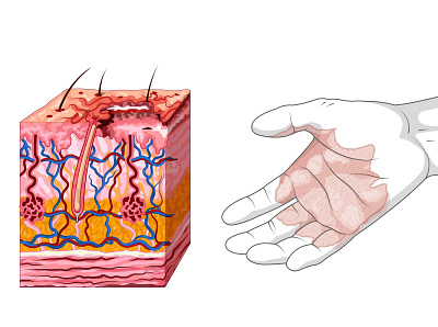 Quemadura de primer grado accidente dermis epidermis fuego hipodermis ilustración didáctica krotalon primeros auxilios quemaura